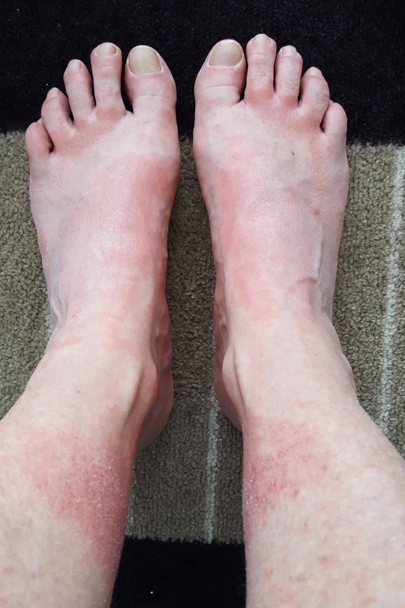 rode vlekken op benen - asfaltbenen