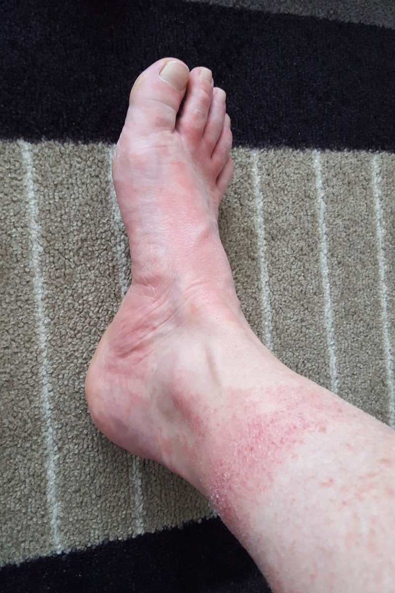 rode vlekken op benen - asfaltbenen