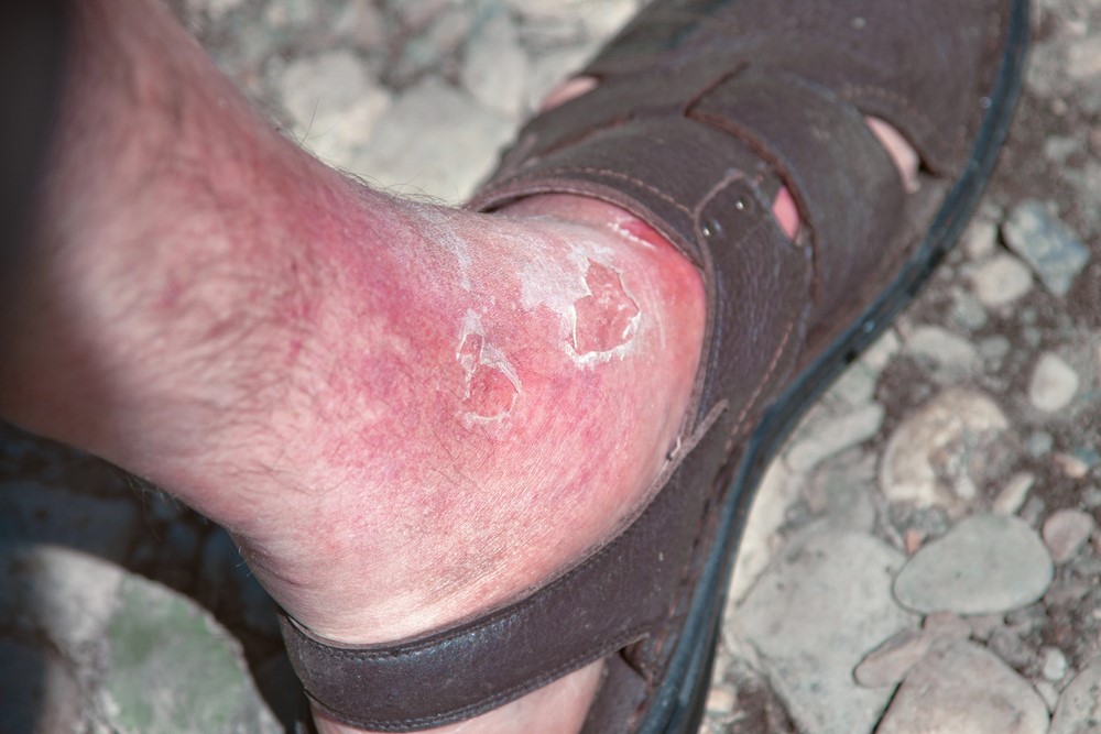 rode vlekken op benen na wandelen